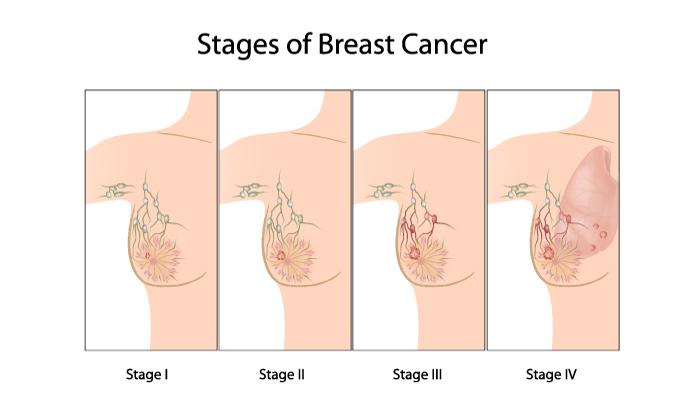 乳腺癌晚期早期图片